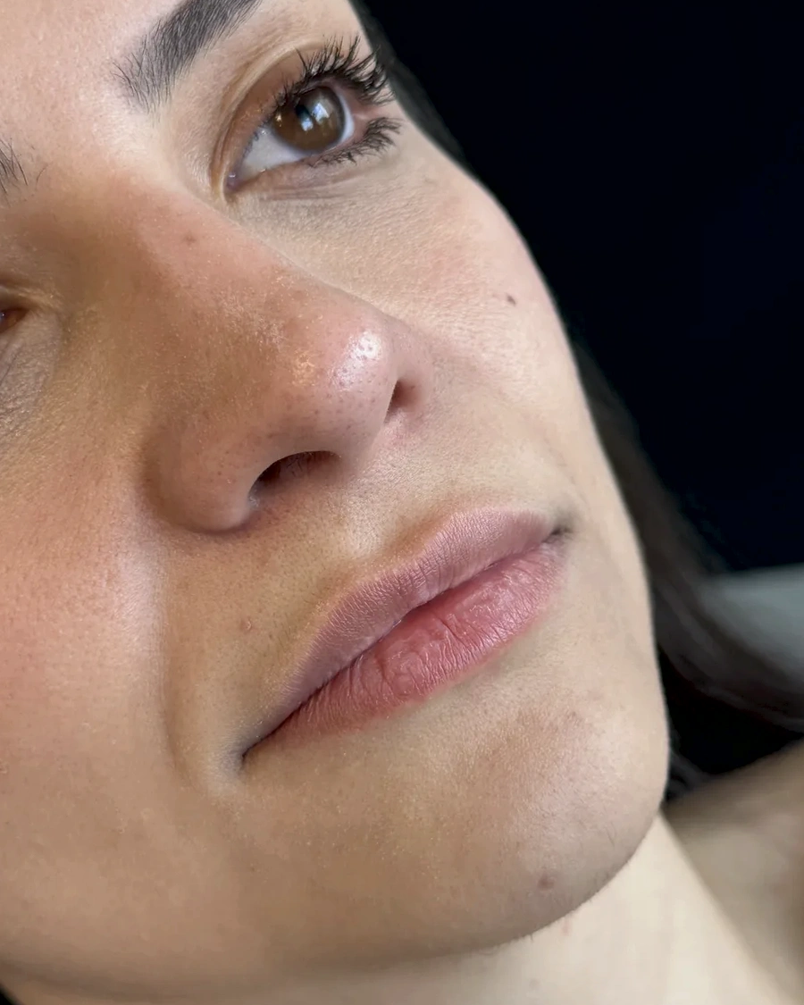 Preenchimento labial, antes (Preenchimento labial)