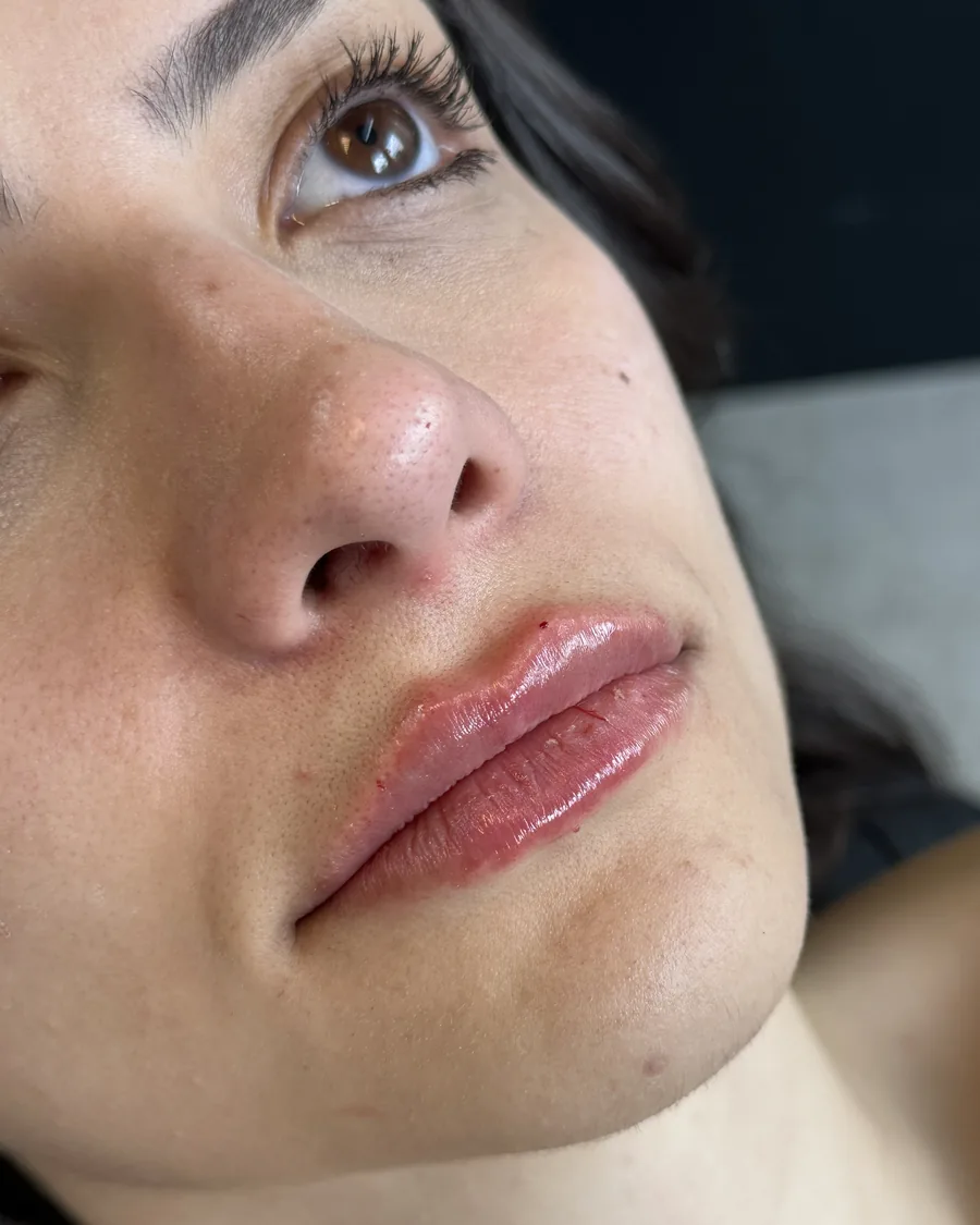 Preenchimento labial, depois (Preenchimento labial)