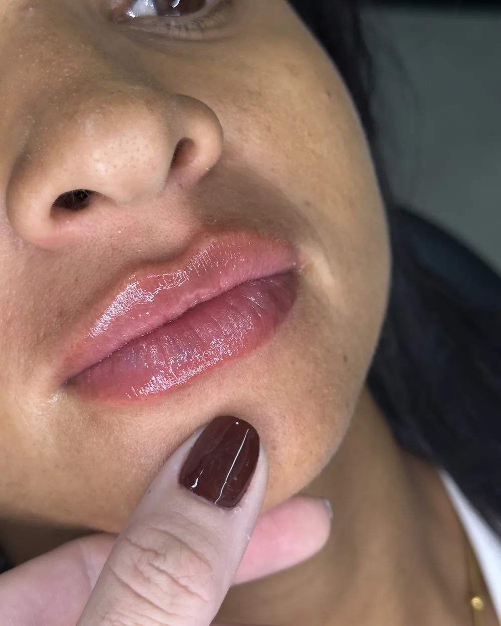 Lábios de paciente após preenchimento labial com a Dra. Ingrid