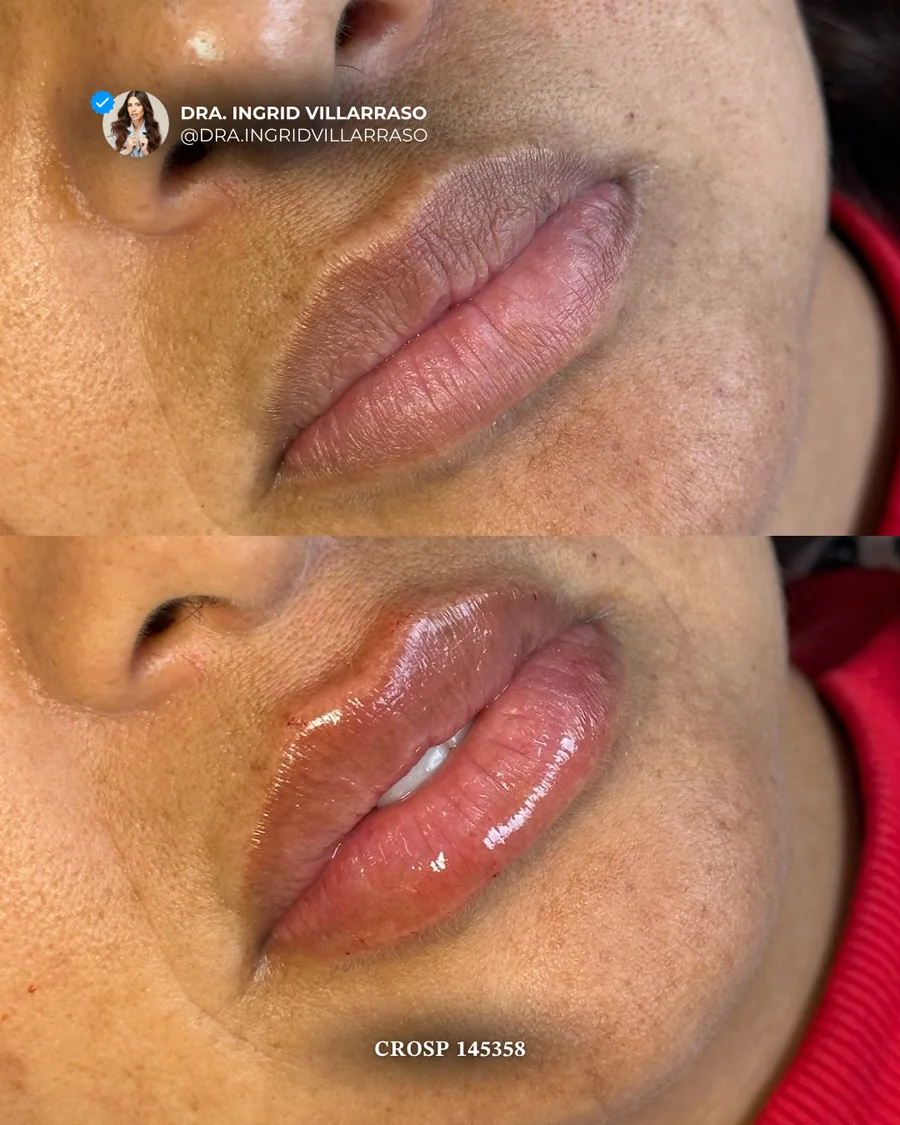 Antes e depois de preenchimento labial